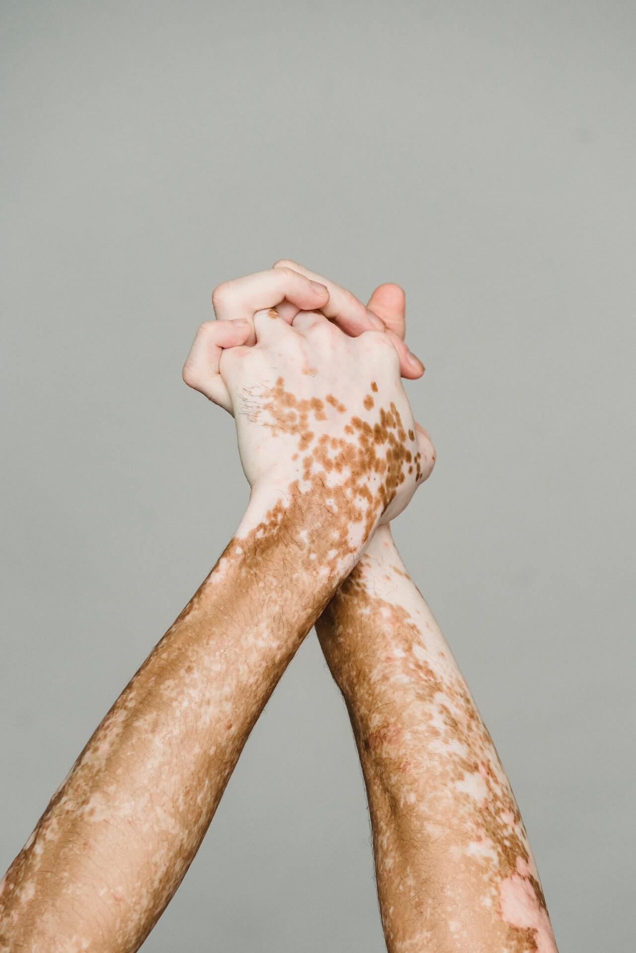 Vitiligo: o que é, causas e muito mais!