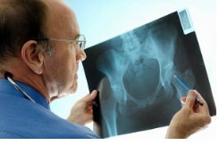 ResuMED de osteoporose, do diagnóstico ao tratamento!