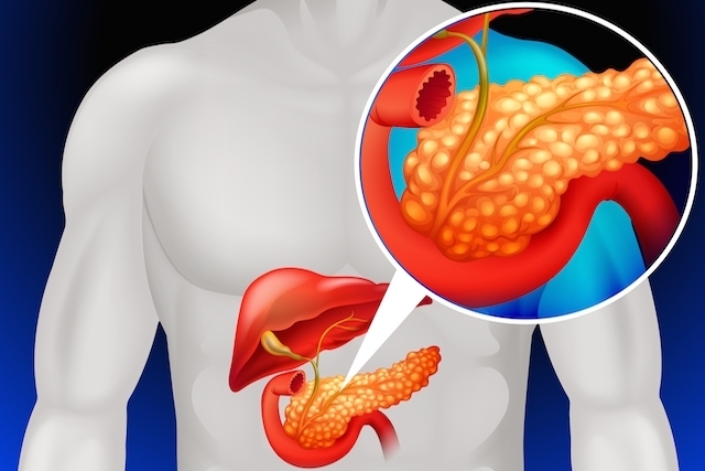 ResuMED de Pancreatite Crônica: classificação, etiologia, diagnósticos e mais!