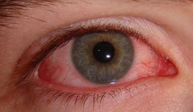 Síndrome do olho vermelho