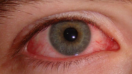 ResuMED de Síndrome do olho vermelho: causas, exames, tratamento e mais!