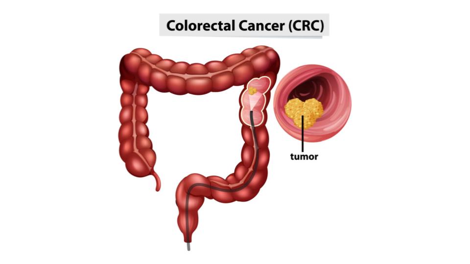 Resumo de câncer colorretal: manifestações clínicas, diagnóstico, tratamento e mais!