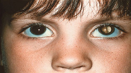 ResuMED de Tumores Oculares Malignos: características, manifestações clínicas e mais!