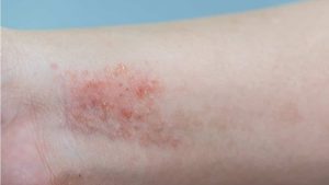 Eczema em punho 