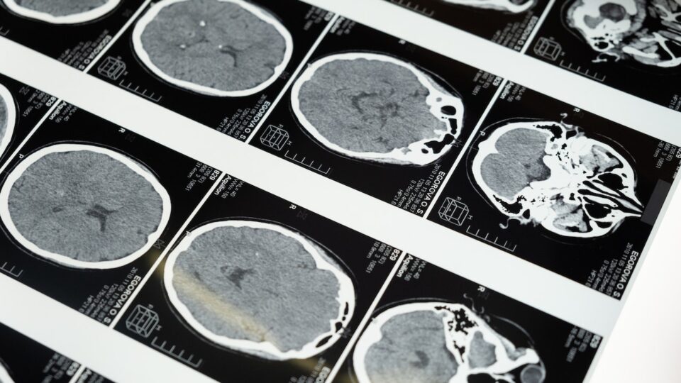Resumo de acidente vascular cerebral isquêmico (AVCi): diagnóstico, tratamento e mais!