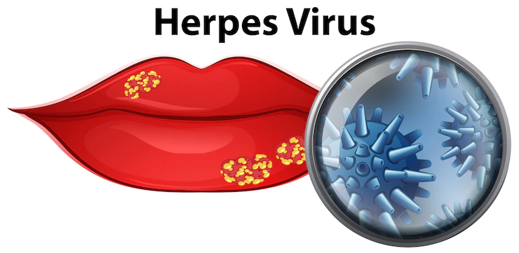Resumo de herpes simples e zóster: diagnóstico, transmissão, tratamento e mais!