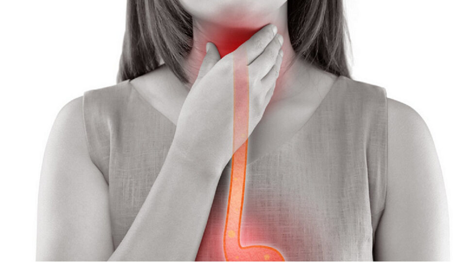 Resumo de refluxo gastroesofágico: diagnóstico, tratamento e mais!