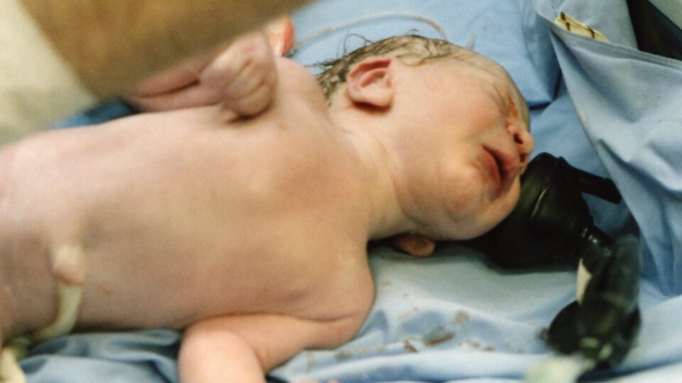 Resumo da atualização do protocolo de hipoglicemia neonatal: diagnóstico, tratamento e mais!