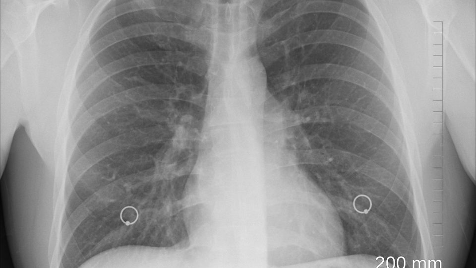 Resumo sobre pneumotórax espontâneo: diagnóstico, tratamento e mais!