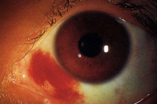 Resumo de Derrame Ocular: conceito, diagnóstico e mais!