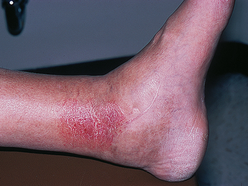 Resumo de Dermatite Ocre: conceito, causas e mais!