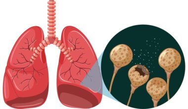 ilustração mostrando fungo nos pulmões