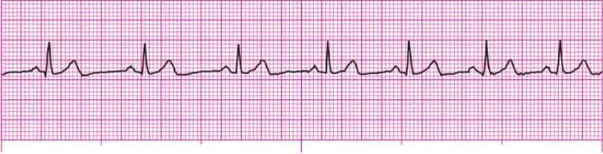 Eletrocardiograma mostrando uma arritmia sinusal