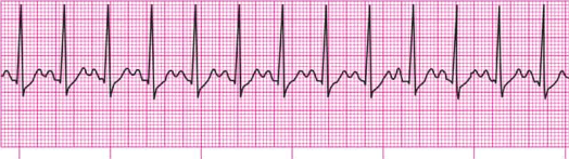 Eletrocardiograma mostrando taquicardia sinusal