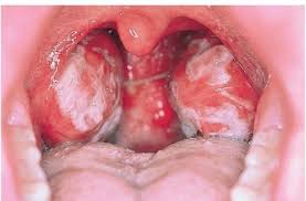 Placas nas tonsilas palatinas